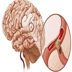 ترکیب اختلالات شیمیایی مغز