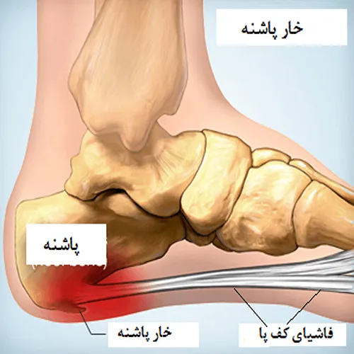 درمان خار پاشنه با گیاهان دارویی